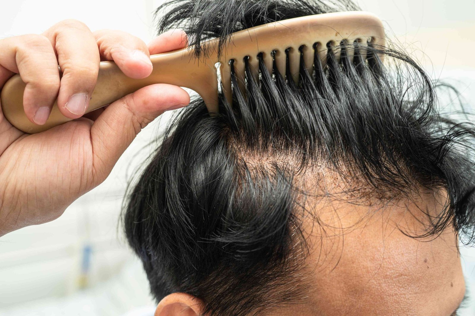 Hair loss